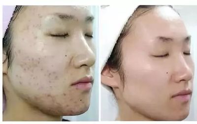 快速去除脸上的痘痘印，这些方法试试